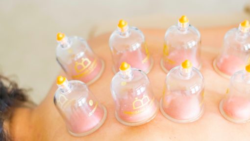 cupping therapy